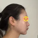 脂肪吸引（顔） / ヒアルロン酸注入（あご） HAAB×DREAM BEAUTY CLINIC 東京本院 DAY 38 サムネイル用