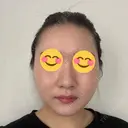 脂肪吸引（顔） / ヒアルロン酸注入（あご） HAAB×DREAM BEAUTY CLINIC 東京本院 DAY 38 サムネイル用