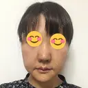 鼻尖形成（切開） / 小鼻縮小（切開） / 鼻尖縮小 湘南美容クリニック 神戸院 AFTER サムネイル用