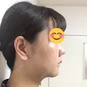 鼻尖形成（切開） / 小鼻縮小（切開） / 鼻尖縮小 湘南美容クリニック 神戸院 DAY 23 サムネイル用