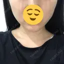 バッカルファット除去 / 脂肪吸引（顔） 湘南美容クリニック 秋葉原院 AFTER サムネイル用