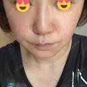 ハイフ（顔） / シミ取りレーザー S-Laboクリニック 渋谷院 AFTER サムネイル用