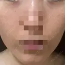 ニードルRF（ポテンツァなど） ながしま形成外科クリニック DAY 2 サムネイル用