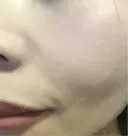 毛穴洗浄（ハイドラフェイシャルなど） / ルメッカ ON-CLINIC Beauty DAY 2 サムネイル用