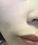 毛穴洗浄（ハイドラフェイシャルなど） / ルメッカ ON-CLINIC Beauty DAY 2 サムネイル用