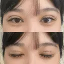 二重埋没 / RF（高周波）たるみ治療 Wing clinic 豊中駅前院 DAY 0 サムネイル用