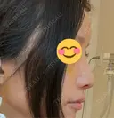 鼻尖形成（切開） / ワシ鼻修正・ハンプ切除 / 眉間プロテーゼ / 鼻柱下降・鼻唇角形成（猫手術） / ヒアルロン酸注入（額） グローバルビューティークリニック 大阪院 DAY 9 サムネイル用