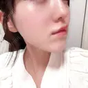 ヒアルロン酸注入（涙袋） / ヒアルロン酸注入（唇） Next Tokyo Clinic AFTER サムネイル用