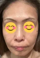 シワ取りボトックス / ピコレーザートーニング（美白・肝斑） / ピコフラクショナルレーザー（毛穴・ニキビ跡） 東京シルククリニック 新宿院 AFTER サムネイル用