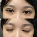 二重埋没 / RF（高周波）たるみ治療 Wing clinic 豊中駅前院 DAY 1 サムネイル用