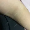 ボトックス（肩） / 高濃度ビタミンC点滴 小倉美容外科/美容皮膚科 ビラビューティークリニック DAY 13 サムネイル用