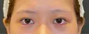 目尻切開 / タレ目形成・グラマラスライン（埋没） LOUIS CLINIC 二子玉川院【ルイクリニック】 DAY 0 サムネイル用