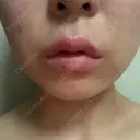 ヒアルロン酸注入（唇） / ボトックス（口角） / RF（高周波）たるみ治療 ルラ美容クリニック 京都院 DAY 5 サムネイル用