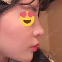 隆鼻術 / 鼻尖形成（切開） / 鼻中隔延長（切開） / 軟骨移植 / 骨切幅寄せ / 斜鼻修正 / 鼻修正 / 鼻尖縮小 GNG美容外科 DAY 84 サムネイル用