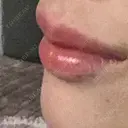 ボトックス（エラ・小顔） / ヒアルロン酸注入（唇） PRO CLINIC プロクリニック 銀座院 AFTER サムネイル用