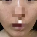 ニードルRF（ポテンツァなど） ながしま形成外科クリニック DAY 3 サムネイル用