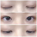 二重埋没 / その他（目元） / 上まぶたの脂肪取り 東京形成美容外科 船橋院 AFTER サムネイル用