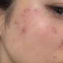 ピコスポット ビューティー和心クリニック 浅草院 DAY 0 サムネイル用