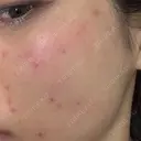 ピコスポット ビューティー和心クリニック 浅草院 DAY 0 サムネイル用