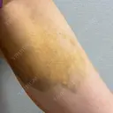 脂肪吸引（顔） / 脂肪吸引（脚） / 脂肪注入（肌） / 脂肪注入（額） / 脂肪注入（目の下） / 脂肪注入（輪郭） ヴェルトラクリニック 新宿院 DAY 6 サムネイル用