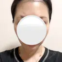 糸リフト / バッカルファット除去 / 脂肪吸引（顔） / ジョールファット除去 / ボトックス（あご） / ボトックス（エラ・小顔） アリエル美容クリニック 大宮院 DAY 52 サムネイル用