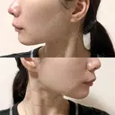 糸リフト / バッカルファット除去 / 脂肪吸引（顔） / ジョールファット除去 / ボトックス（あご） / ボトックス（エラ・小顔） アリエル美容クリニック 大宮院 DAY 52 サムネイル用