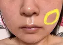 糸リフト / バッカルファット除去 / ボトックス（エラ・小顔） / ヒアルロン酸注入（頬） / フラクショナルレーザー（毛穴・ニキビ跡） TCB東京中央美容外科 仙台駅前院 DAY 5 サムネイル用