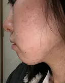 脂肪溶解注射（顔） 湘南美容クリニック 大宮院 DAY 13 サムネイル用