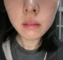脂肪溶解注射（顔） 湘南美容クリニック 大宮院 DAY 17 サムネイル用