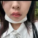 ヒアルロン酸注入（唇） / ボトックス（口角） ルラ美容クリニック 大阪本院 DAY 0 サムネイル用