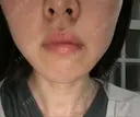 脂肪溶解注射（顔） 湘南美容クリニック 大宮院 DAY 18 サムネイル用