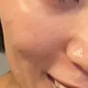 水光注射（ハリ・美肌） 品川美容外科 新宿院（※品川スキンクリニック提携） DAY 3 サムネイル用