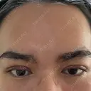 眼瞼下垂（切開） / 上まぶたの脂肪取り 新前橋かしま眼科形成外科クリニック DAY 5 サムネイル用