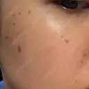 ピコスポット ビューティー和心クリニック 浅草院 DAY 2 サムネイル用