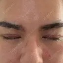 眼瞼下垂（切開） / 上まぶたの脂肪取り 新前橋かしま眼科形成外科クリニック DAY 5 サムネイル用