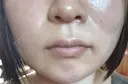 糸リフト / バッカルファット除去 / ボトックス（エラ・小顔） / ヒアルロン酸注入（頬） / フラクショナルレーザー（毛穴・ニキビ跡） TCB東京中央美容外科 仙台駅前院 DAY 6 サムネイル用