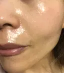 毛穴洗浄（ハイドラフェイシャルなど） / ルメッカ ON-CLINIC Beauty DAY 7 サムネイル用