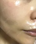 毛穴洗浄（ハイドラフェイシャルなど） / ルメッカ ON-CLINIC Beauty DAY 7 サムネイル用