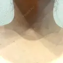 ボトックス（肩） 大美会クリニック 京都烏丸院 DAY 19 サムネイル用