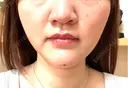 ボトックス（あご） / ボトックス（エラ・小顔） TCB東京中央美容外科 天王寺院 AFTER サムネイル用