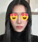 小鼻縮小（切開） くさのたろうクリニック AFTER サムネイル用