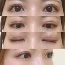 眼瞼下垂（切開） / 上まぶたの脂肪取り 白山クリニック 大分 DAY 23 サムネイル用