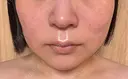 糸リフト / バッカルファット除去 / ボトックス（エラ・小顔） / ヒアルロン酸注入（頬） / フラクショナルレーザー（毛穴・ニキビ跡） TCB東京中央美容外科 仙台駅前院 DAY 8 サムネイル用