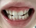 ホワイトニング 池袋きのした歯科・矯正歯科 AFTER サムネイル用