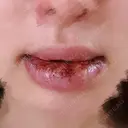 口唇縮小術 Kono Clinic DAY 4 サムネイル用