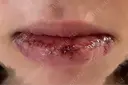 口唇縮小術 Kono Clinic DAY 4 サムネイル用