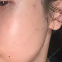 ピコスポット ビューティー和心クリニック 浅草院 DAY 5 サムネイル用