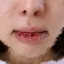 口唇縮小術 Kono Clinic DAY 5 サムネイル用