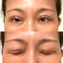 二重切開 水の森美容クリニック 大阪梅田院 DAY 8 サムネイル用