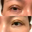 二重切開 水の森美容クリニック 大阪梅田院 DAY 8 サムネイル用